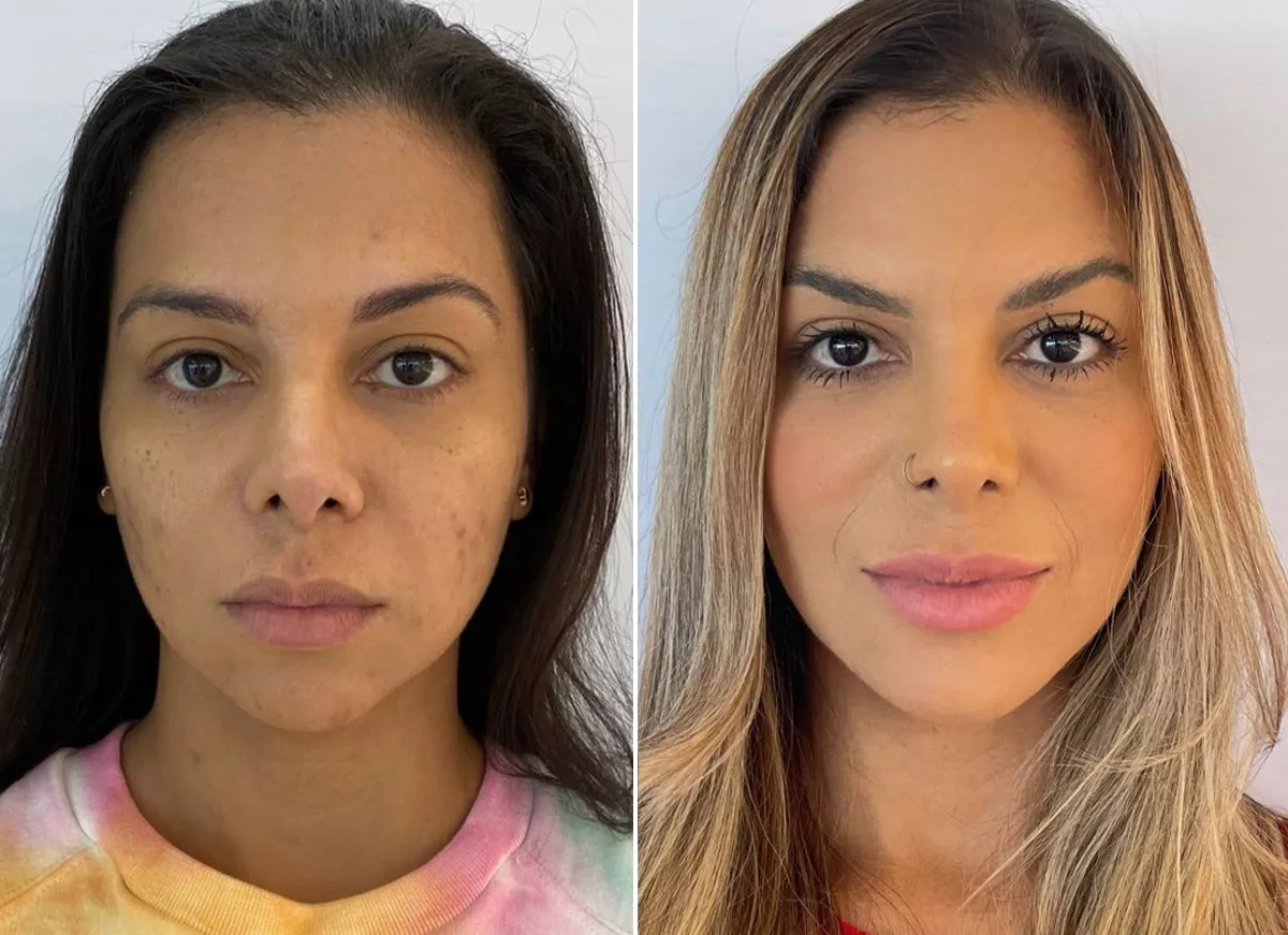 Resultado 6 - Uniformização do tom de pele